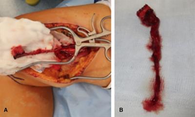 Does indocyanine green fluorescence angiography impact the intraoperative choice of procedure in free vascularized medial femoral condyle grafting for scaphoid nonunions?